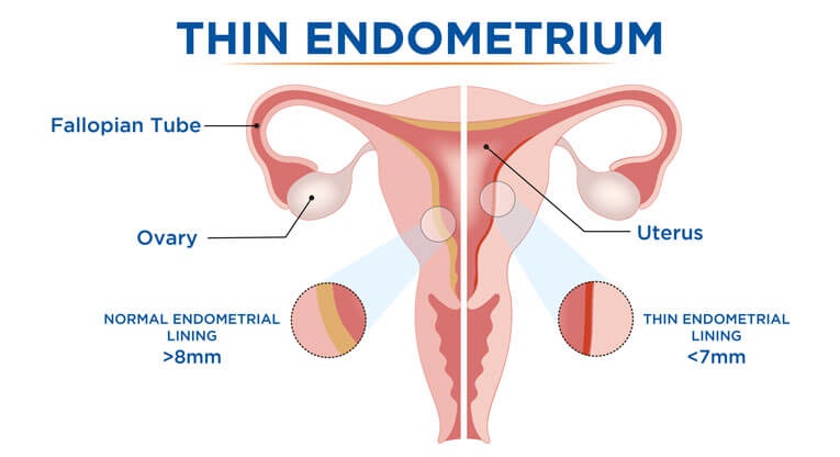 Thin Endometrium Symptoms Causes And Treatment Options
